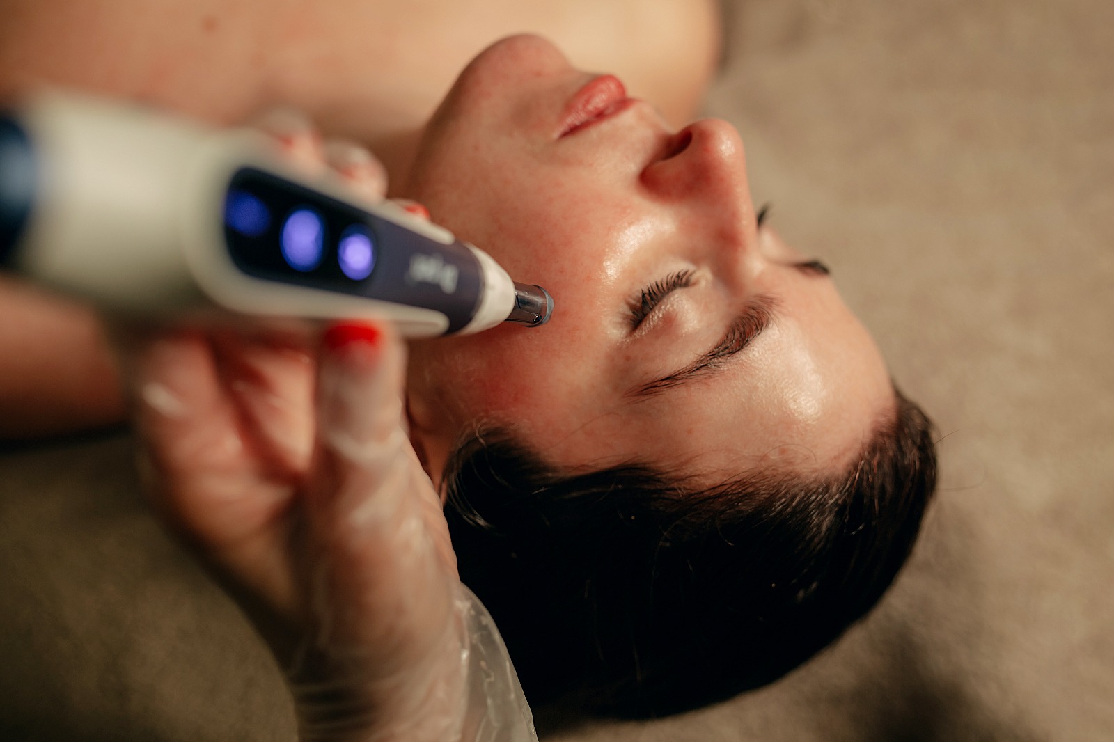 Microagulhamento facial clínica estética Porto