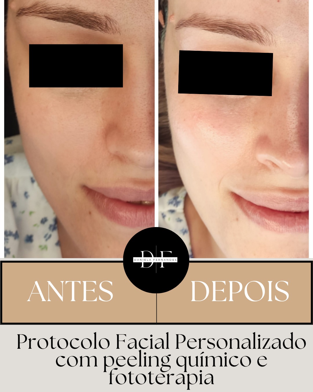 Antes e Depois