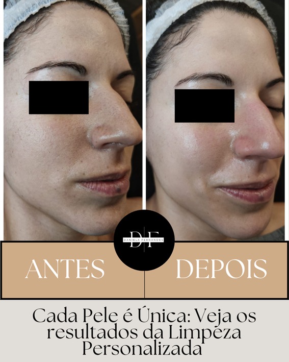 Antes e depois microagulhamento Porto