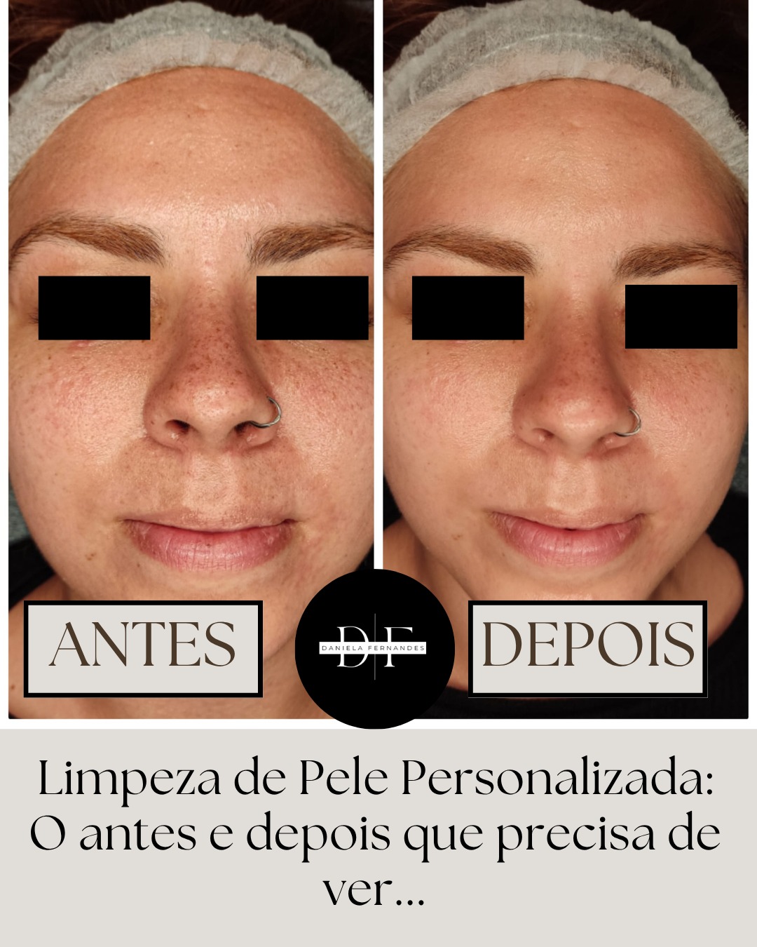 Resultado radiofrequência facial clínica