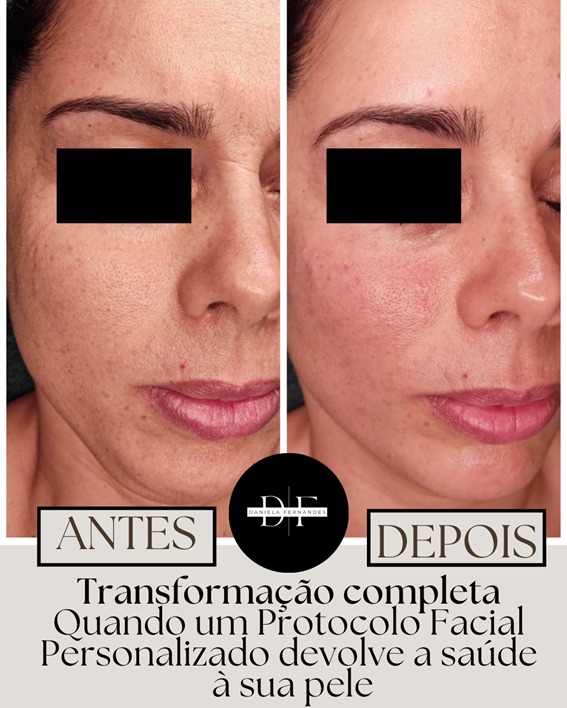 Melhoria textura pele após tratamento