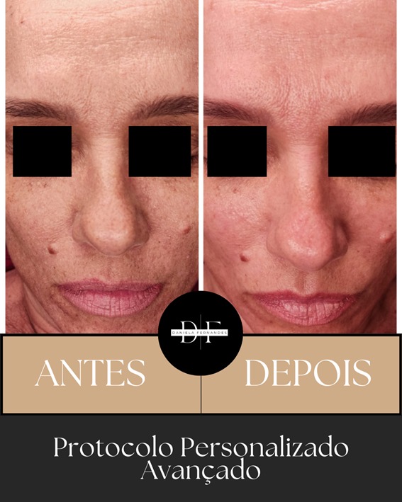 Antes e Depois